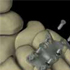 thumbnail of Lisfranc Fracture